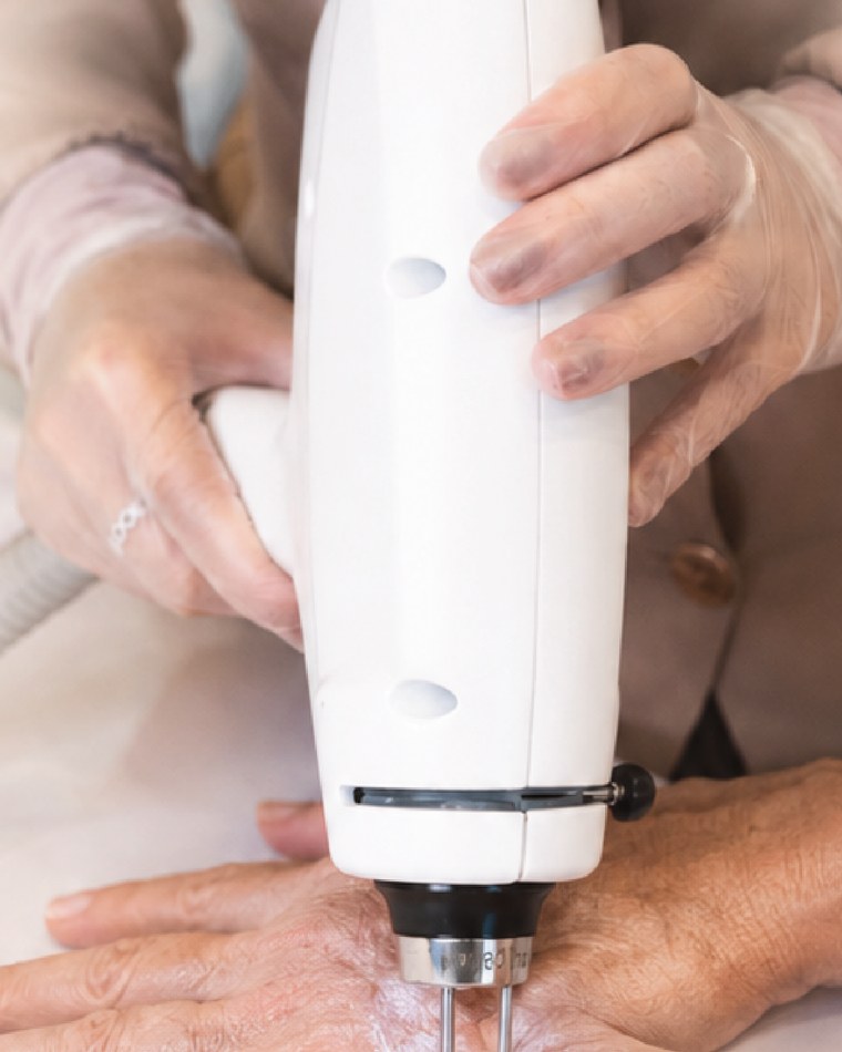Sessão de rejuvenescimento de mãos a laser na Laser & Co